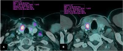 Diagnostic Value of FDG PET-CT Quantitative Parameters and Deauville-Like 5 Point-Scale in Predicting Malignancy of Focal Thyroid Incidentaloma